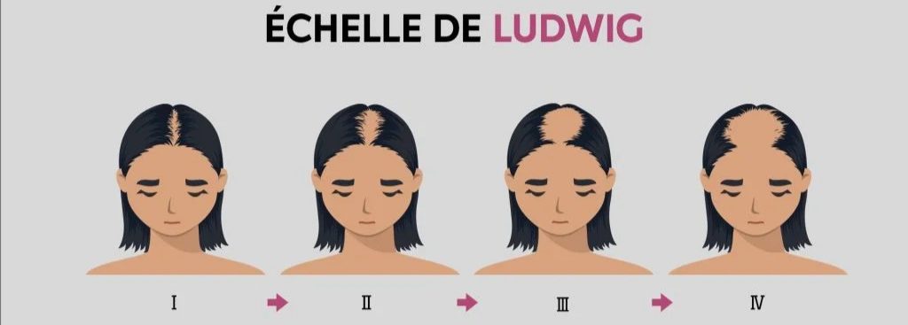 image de tête de femme décrivant les 4 stades de chute de cheveux selon échelle de LUDWIG