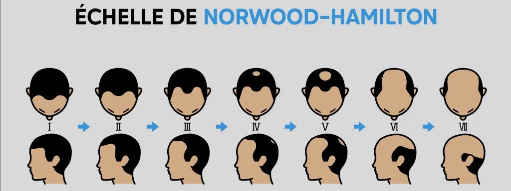 image de tête d'homme décrivant les 7 stades de chute de cheveux selon échelle de NORWOOD